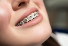Braces in Penrith Modern Options for Every Lifestyle
