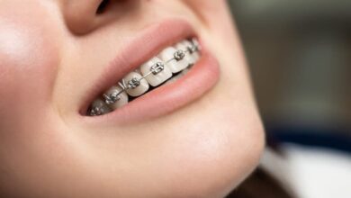 Braces in Penrith Modern Options for Every Lifestyle