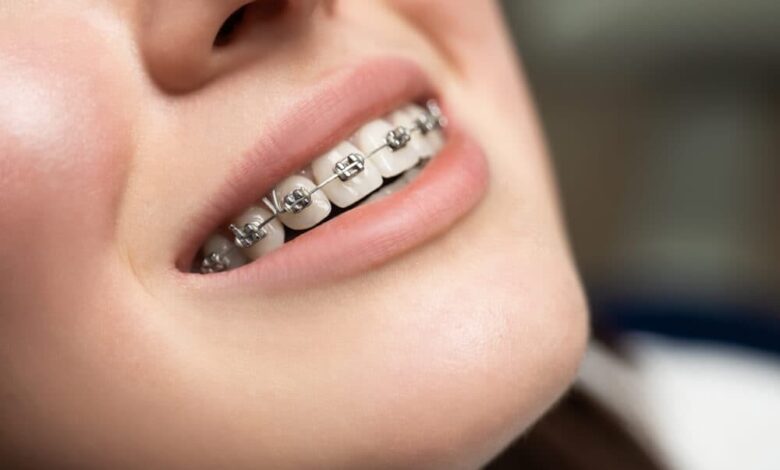 Braces in Penrith Modern Options for Every Lifestyle
