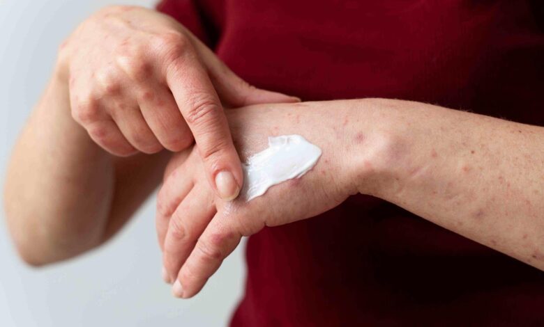 How to Choose the Right Eczema Cream for Your Skin Type and Needs