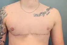 Surgery